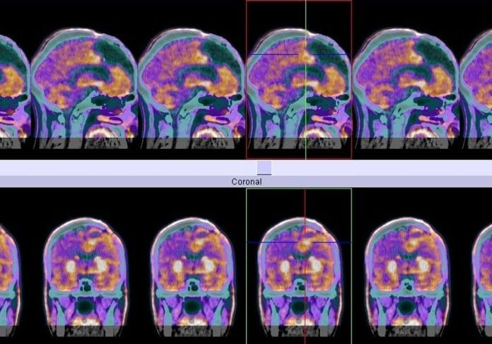 PET scan of glioblastoma cancer