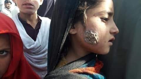 A child affected by Leishmaniasis in Pakistan | @DrBadarAwan5/Twitter