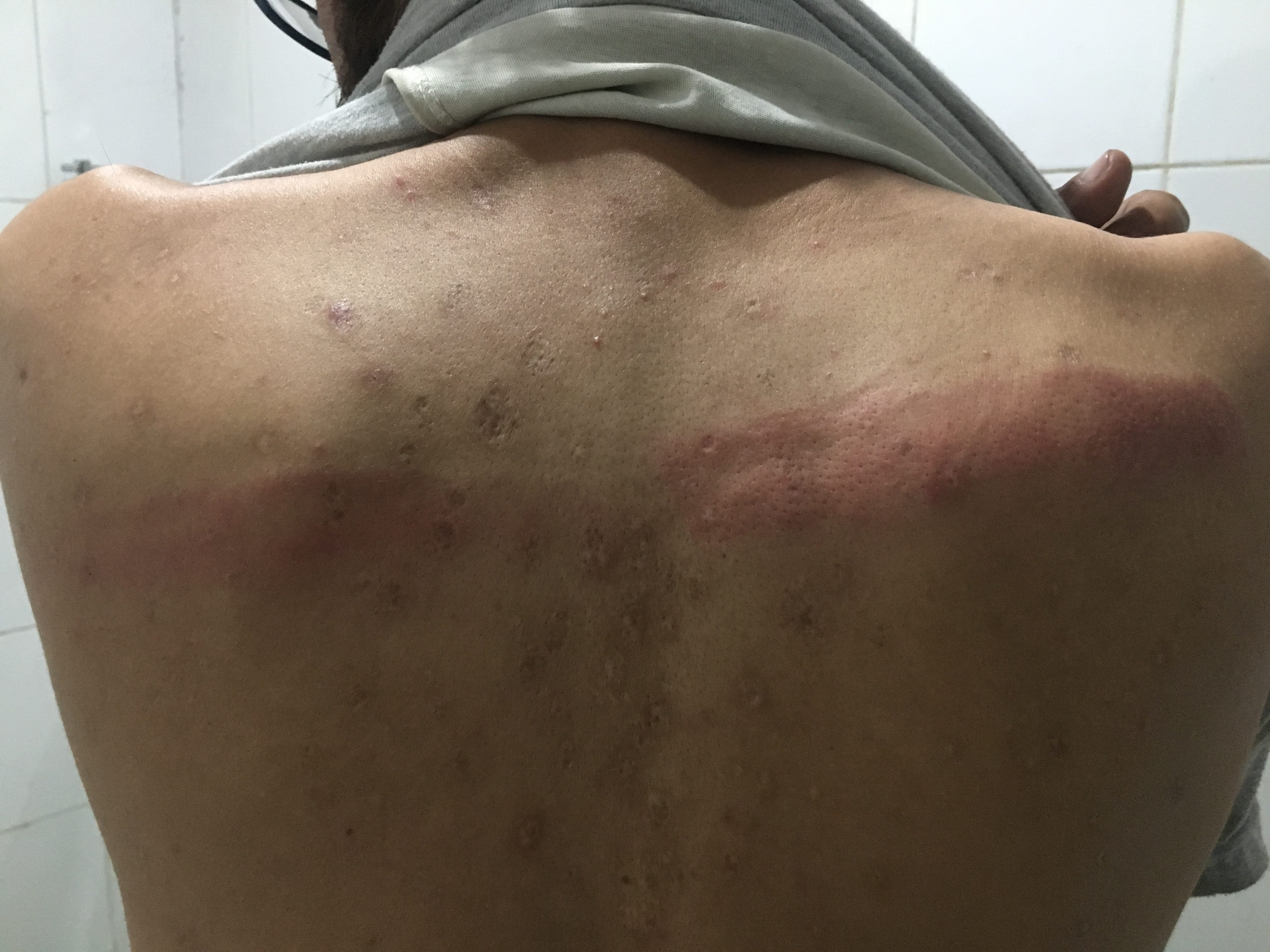 An injured journalist shows the pellet marks and injuries he sustained. | Photo: Azaan Javaid | ThePrint