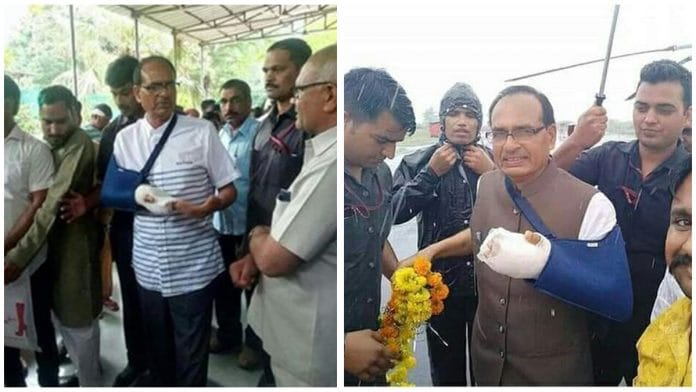 Viral photo showing Shivraj Singh Chouhan's fractured arm