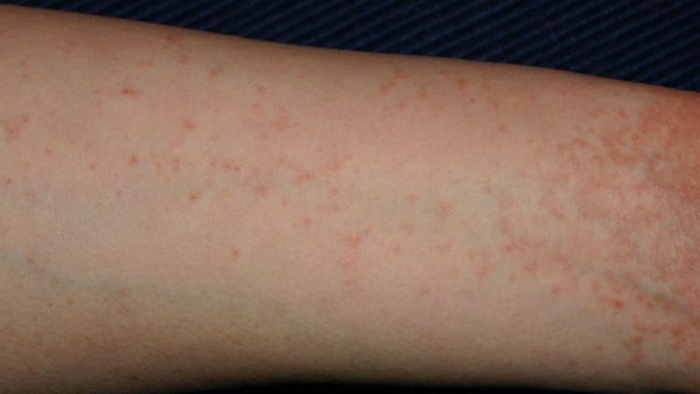 455 million people get this disease every year. But no one talks about it