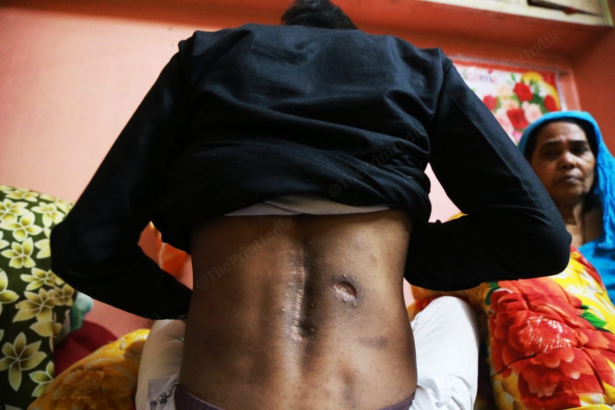 He was shot in the hip area | Photo: Manisha Mondal | ThePrint