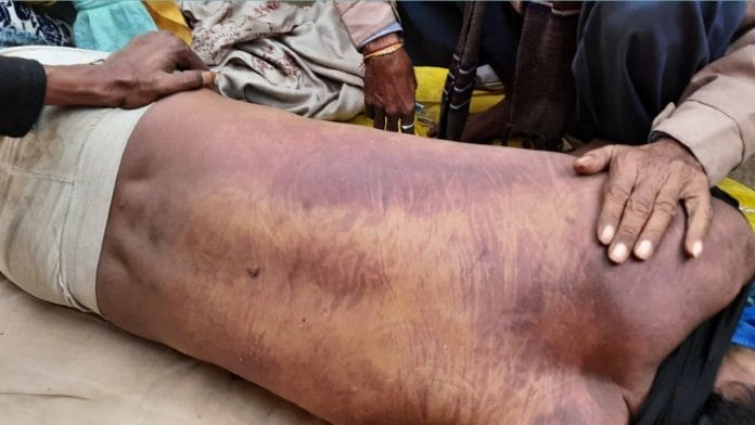 The bluish marks on Jitendra Srivastav alias Kallu's corpse | By special arrangement