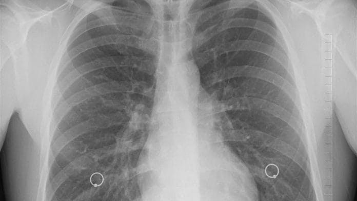 X-ray image of a person's lungs | Representional image | pixabay.com