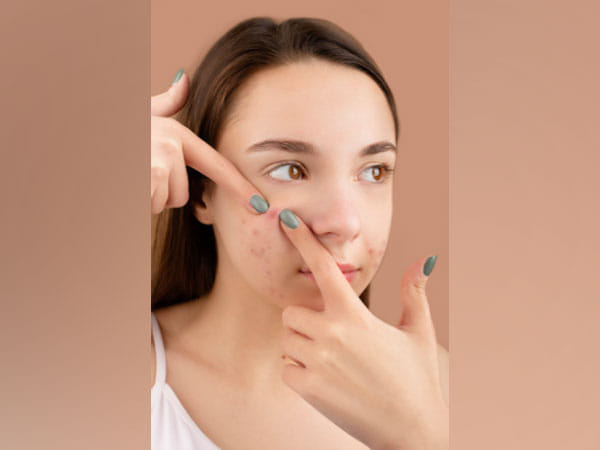 Research finds how fat cells in skin help fight acne