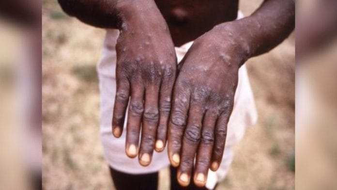 Massachusetts public health officials confirm case of monkeypox