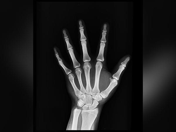 Bone fractures in cancer patients can be predicted using AI: Research