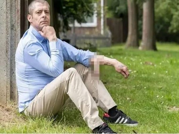 Man lost his penis, had new one attached to his arm for six years, now is a 'real man' again