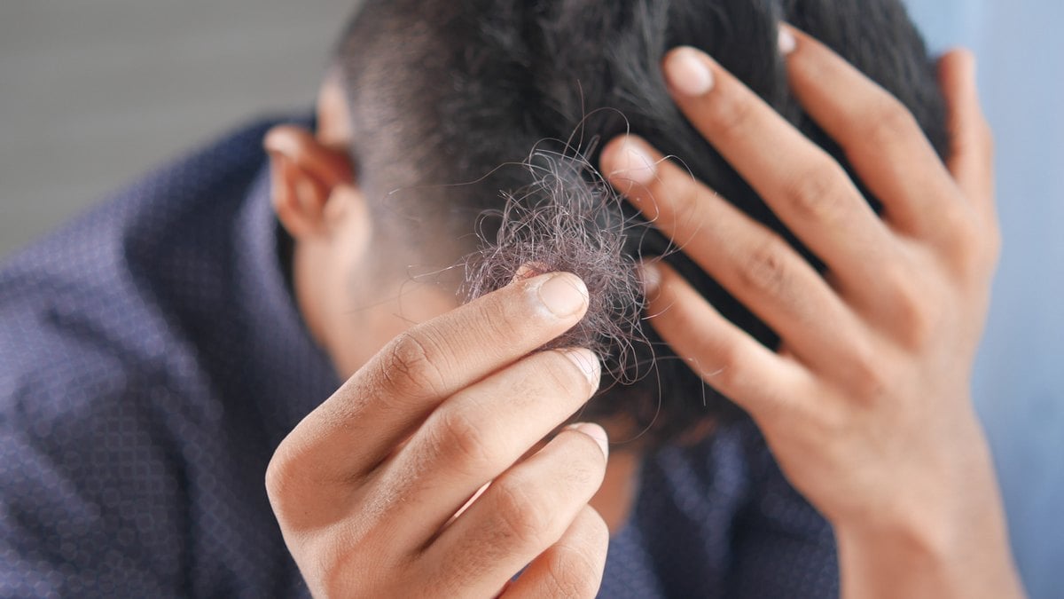 Hair-loss drugs are Wall Street’s next Ozempic-like bet. But what’s new in the science
