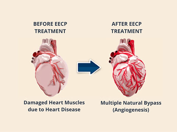 Know why EECP is an alternative to Bypass Surgery