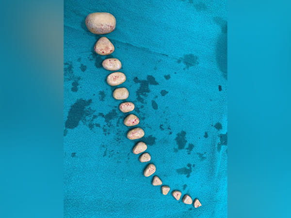 Doctors remove 16 stones weighing 500 gms from paralyzed man's bladder in Delhi hospital