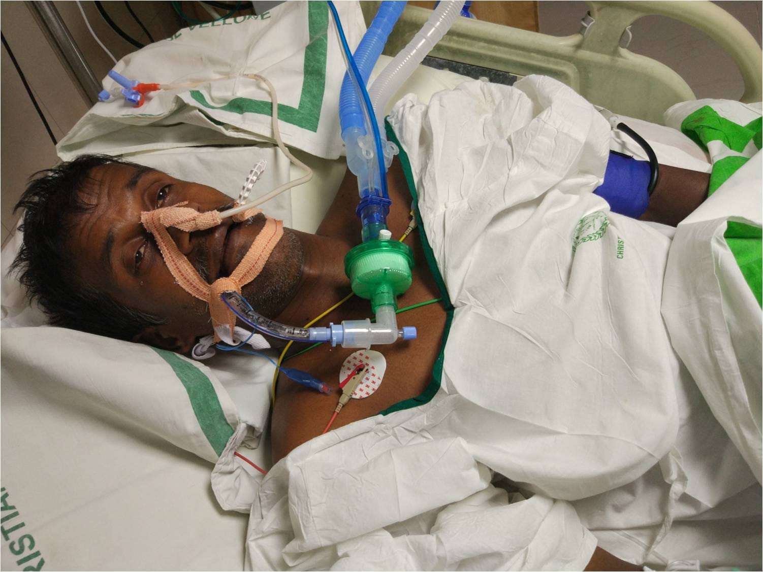 A snakebite victim undergoing treatment at Christian Medical College, Vellore. | Photo Credit: CMC Vellore