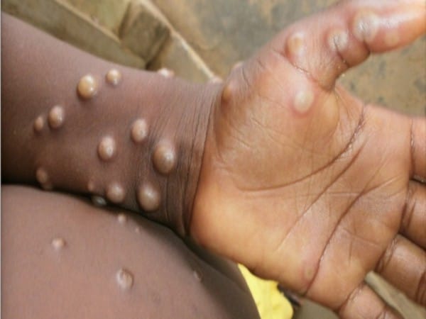 Delhi reports second Monkeypox case, Nigerian man with no travel history infected