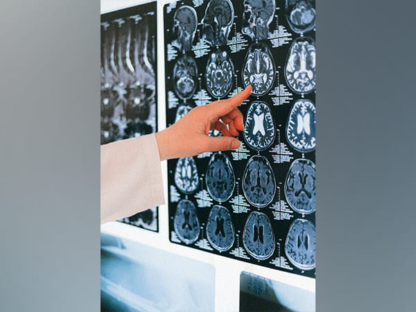 Study finds how words and face recognition can be adequately supported with half a brain