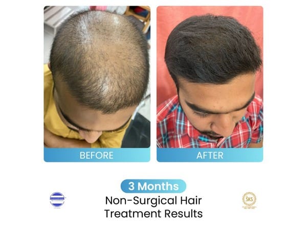 Dr Stuti Khare Shukla's Non-Surgical Hair Growth Booster helping multiple people suffering from Hair Loss Issues