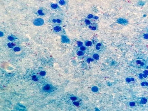 What is Marburg disease and should India be worried? 