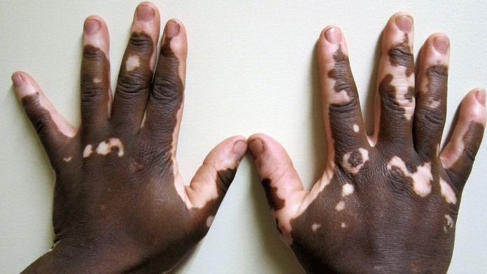 Representative image: Vitiligo | Wikimedia
