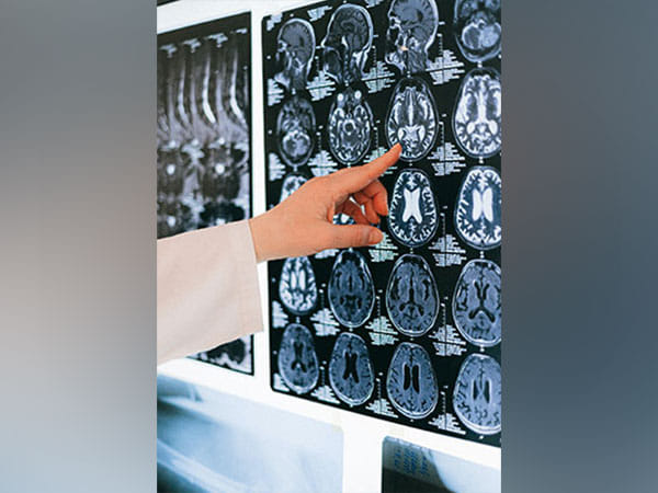 Research: Alzheimer's development linked to cholesterol, toxic protein clusters