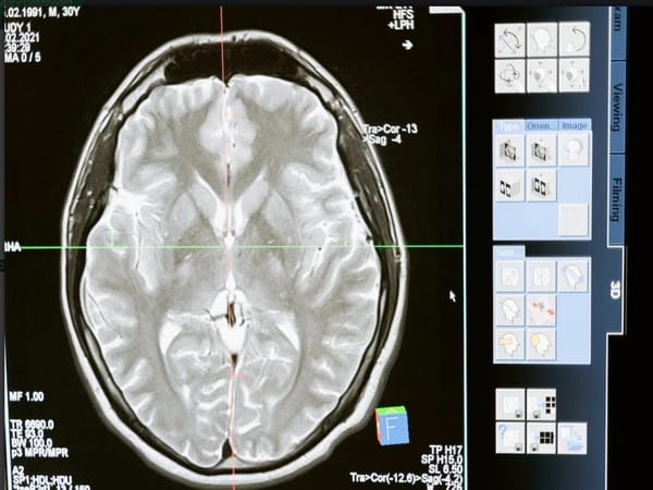 Study identifies brain network connections associated with anosognosia