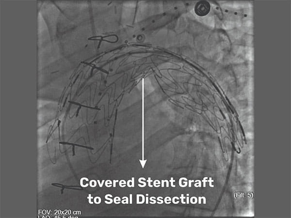 Medical Marvel at SSB Heart and Multispeciality Hospital: Pioneering Hybrid Procedure Saves a Life
