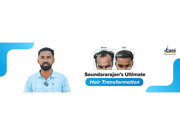 Reversing baldness with VCare