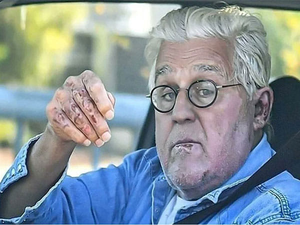 Jay Leno suffers eye injury after falling down a hill 