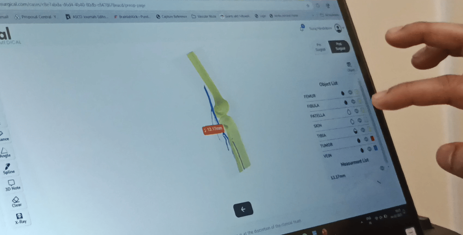 User-friendly segmentation software used for surgery planning, at Sparsh Hospital | Photo: Ananthapathmanabhan, ThePrint