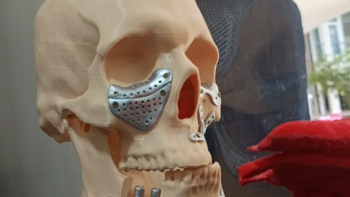 3D printed implant (steel colour) using flesh-friendly materials, at Sparsh Hospital, Bengaluru | Photo: Ananthapathmanabhan