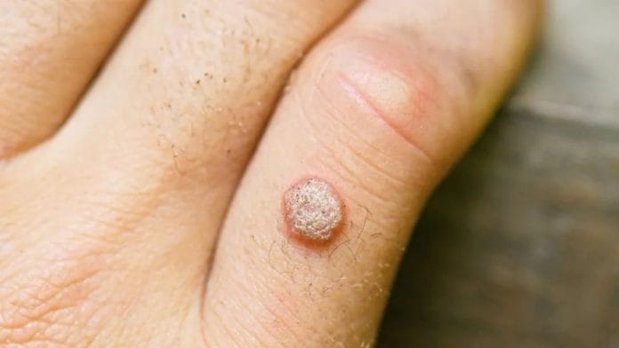 Close-up of viral warts on the skin, showing texture and common features