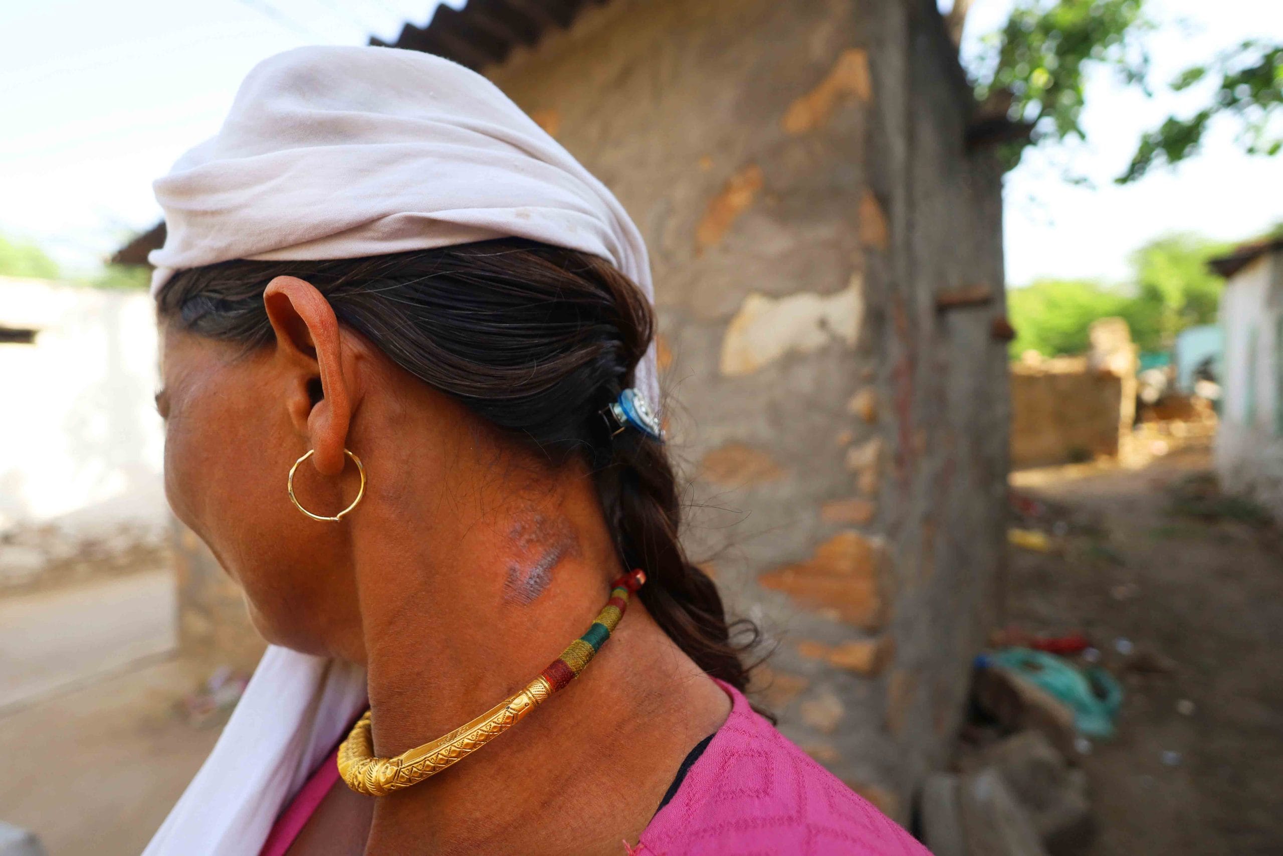Women working in fields near waste burning units regularly develop rashes and allergies