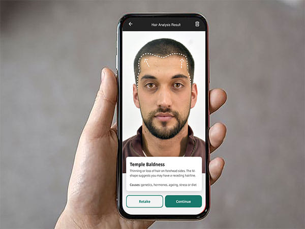 Cureskin to Launch World's First AI-Powered Hair Analyser to Combat Baldness on 20th April 2025