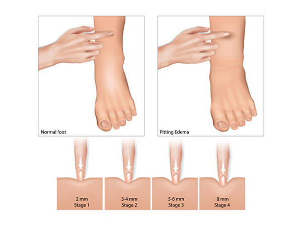 What is the most common cause of fluid retention and how it affects your blood pressure?
