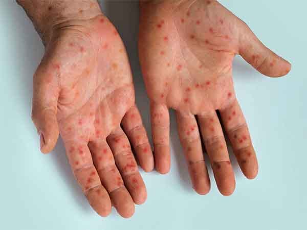 US measles cases cross 2,200. Set to shatter 35-year record