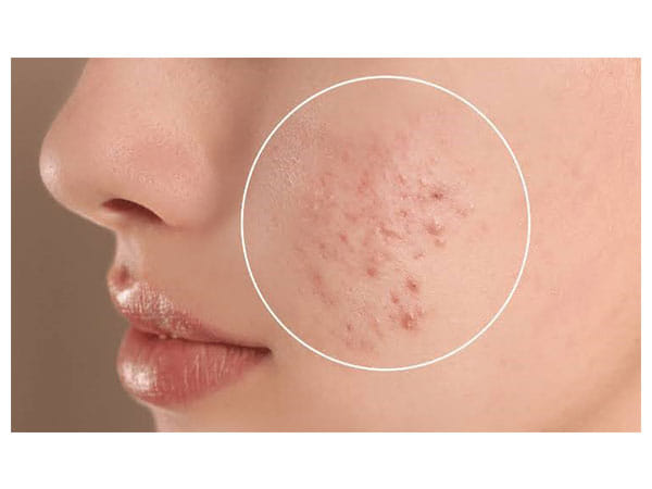 How to Treat Acne and Pigmentation?
