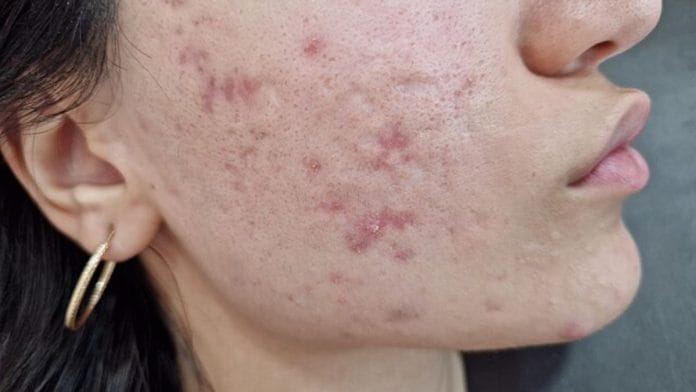 PCOS acne is deeper, more rooted, cystic, and stubborn