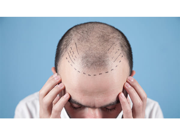 Dermatologist vs. Hair Transplant Surgeon: Who's Best for Hair Transplant Surgery?