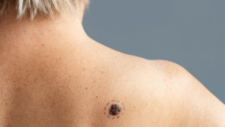 Skin cancer is no more an ‘old person’s disease’