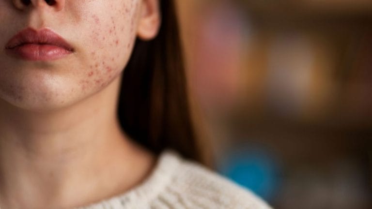 Exact root cause of rosacea skin disease is a mystery. It steals confidence and comfort