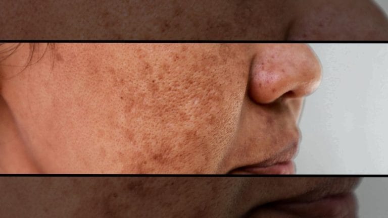 How to treat melasma—strict sun protection, oral therapies and targeted lasers