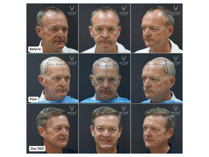 India's Medical Tourism Boom: How Musk Clinic is Shaping the Global Aesthetics & Hair Restoration Demand