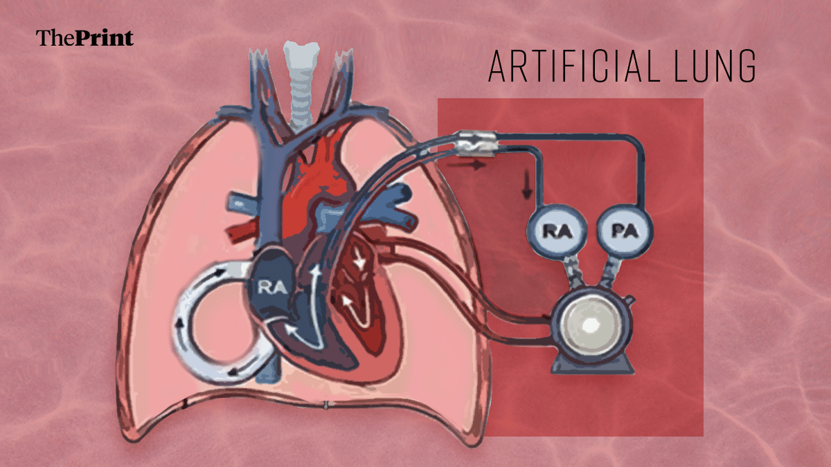 A US man lived two days without lungs. Why it can revolutionise transplant practice