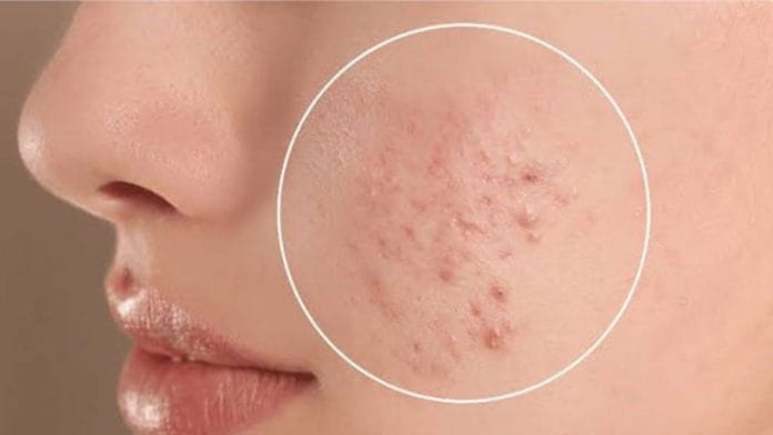 Higher pH levels are common in conditions like eczema, acne, and sensitive skin