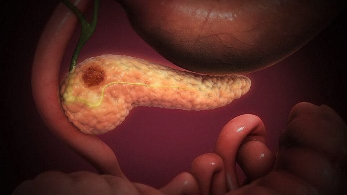 Cancerous cells forming a lump in the pancreatic tissue | Credit: Commons