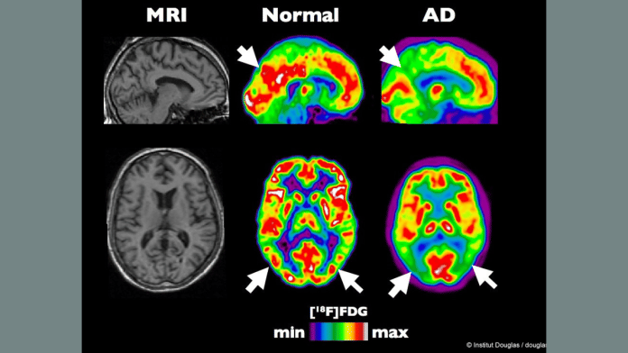 PET scan of a healthy brain compared to another at an early stage of Alzheimer's disease | Flickr