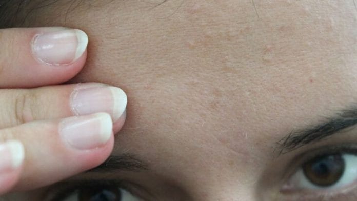 Recognising fungal acne early can save time, money, and emotional distress. | Representational image | Commons