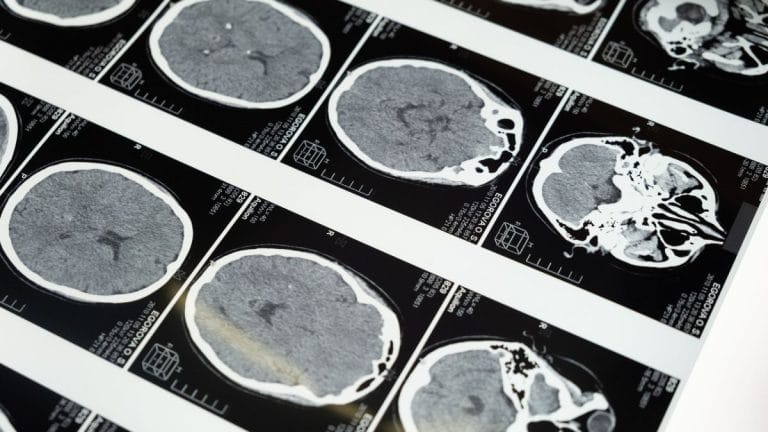 Poor sleep affects brains differently. Especially older women