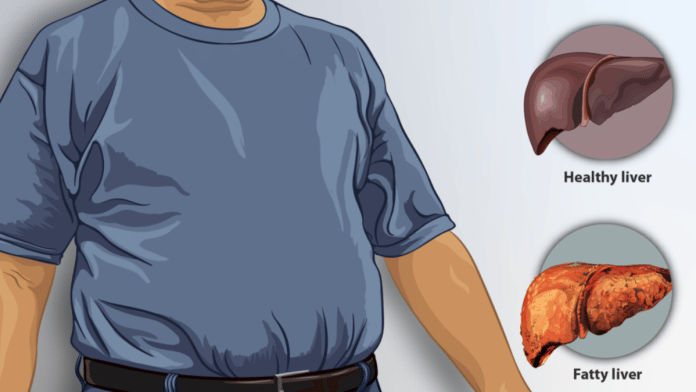 Representational image of a man suffering from fatty liver | Commons