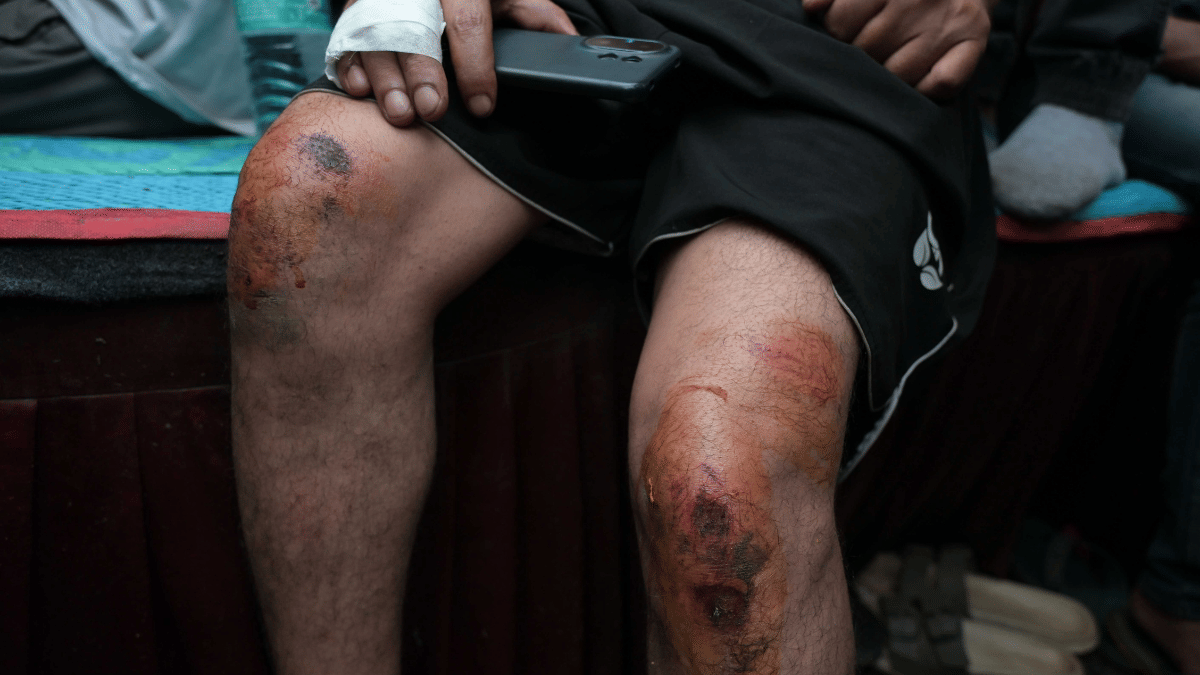 A student shows injuries he sustained in police lathicharge on Monday. | Suraj Singh Bisht/ThePrint