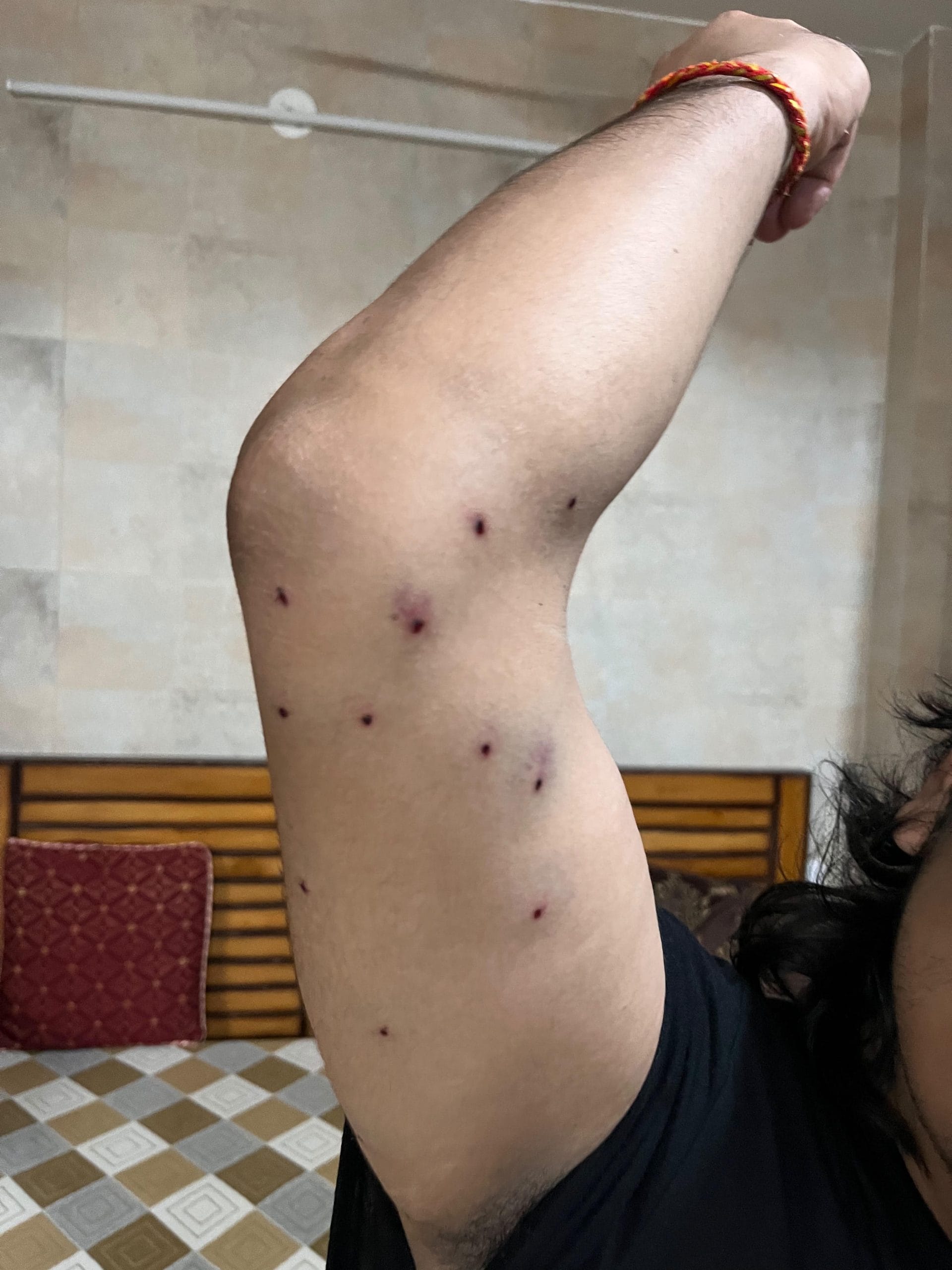 A journalist show pellet gun injuries on his right hand | By special arrangement