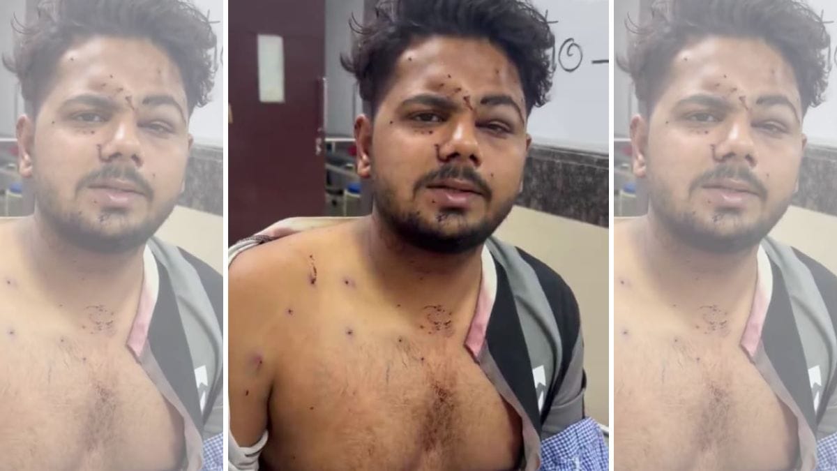 Shaikh Irshad Mansoori sustained pellet gun injuries in his left eye, lower chin, shoulder and chest. | Photo by special arrangement